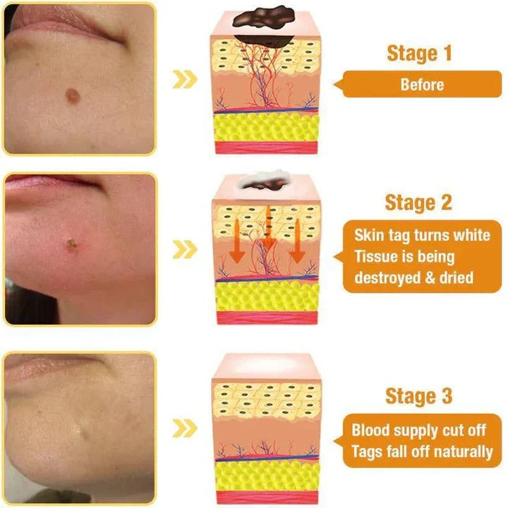 TAG RECEDE ✨ Elimina Manchas y Verrugas SIN Dolor  – Ideal para Piel Sensible ✨ ¡PAGA 1 LLEVA 2!👇